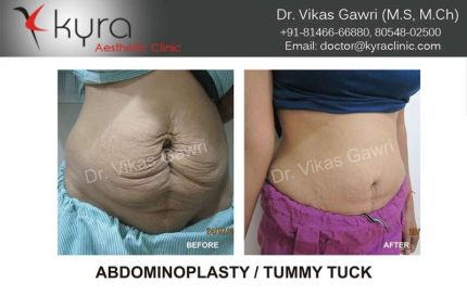 Abdominoplasty Tummy Tuck