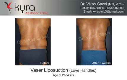 Before and After Liposuction at Kyra Clinic in Ludhiana