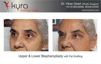 Before and After blepharoplasty or eyelid surgery in Ludhiana