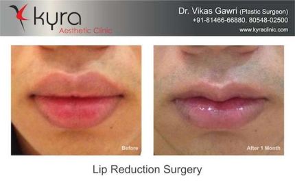 Before and after lip Surgery in Ludhiana