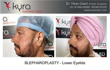 Blepharoplasty (Eyelid Surgery) at Kyra Clinic in Ludhiana