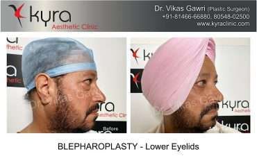 Blepharoplasty Lower Eyelids