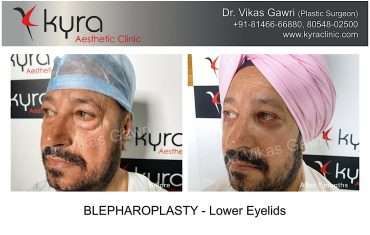 Blepharoplasty Lower Eyelids