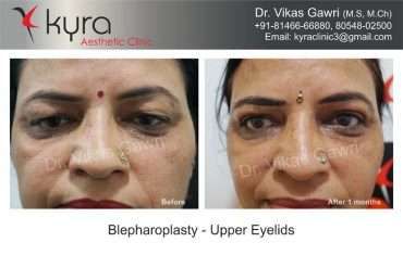 Blepharoplasty Upper Eyelids