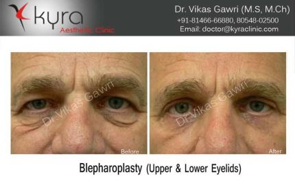 Blepharoplasty Upper Lower Eyelids