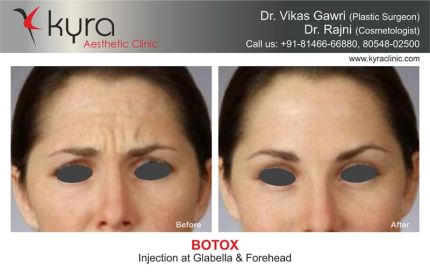 Botox Inj At Glabella Forehead