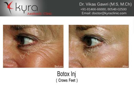 Botox Injection Crows Feet