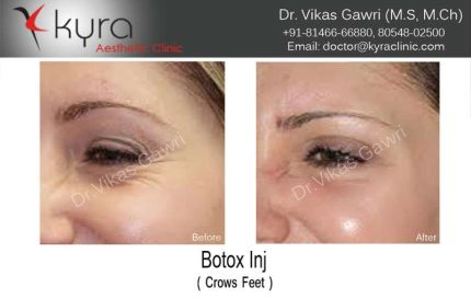 Botox Injection Crows Feet