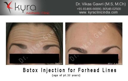 Botox Injection For Forhead Lines