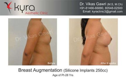 Breast Augmentation Silicone Implants