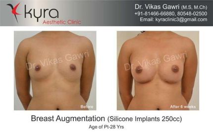 Breast Augmentation Silicone Implants