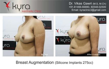 Breast Augmentation Silicone Implants