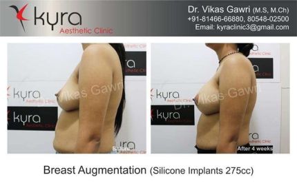 Breast Augmentation Silicone Implants