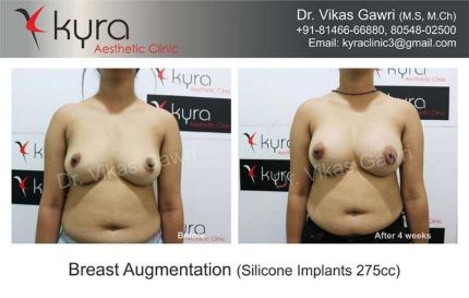 Breast Augmentation Silicone Implants