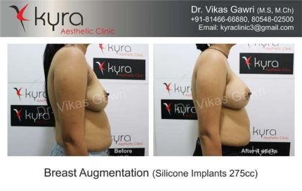 Breast Augmentation Silicone Implants