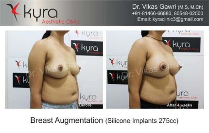 Breast Augmentation Silicone Implants