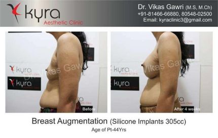 Breast Augmentation Silicone Implants