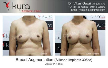 Breast Augmentation Silicone Implants