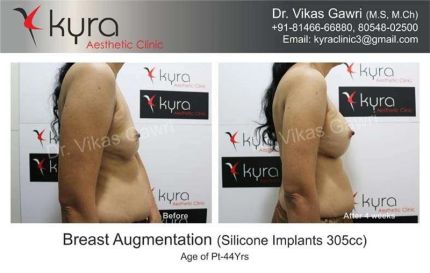 Breast Augmentation Silicone Implants