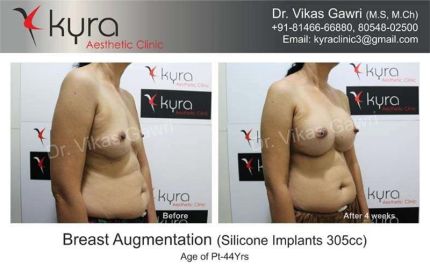 Breast Augmentation Silicone Implants