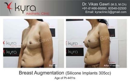 Breast Augmentation Silicone Implants