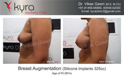 Breast Augmentation Silicone Implants