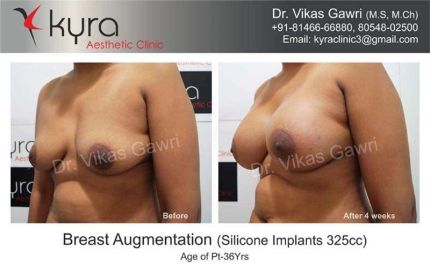 Breast Augmentation Silicone Implants