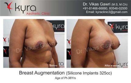 Breast Augmentation Silicone Implants