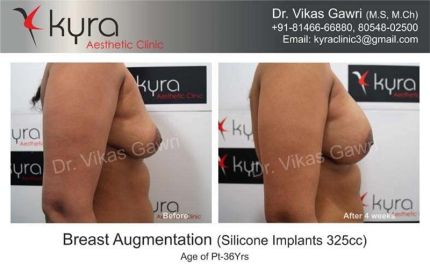 Breast Augmentation Silicone Implants