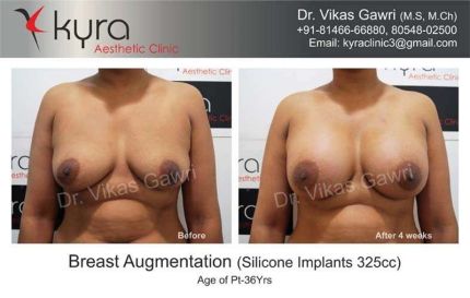 Breast Augmentation Silicone Implants