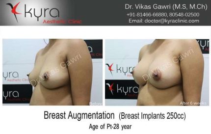 Breast-Augmentation