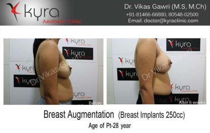 Breast Augmentation