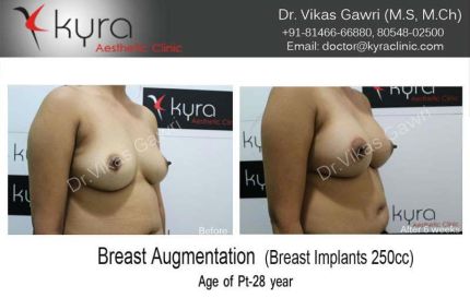 Breast Augmentation