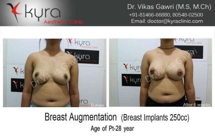 Breast Augmentation