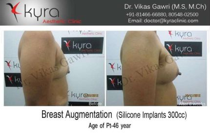 Breast Augmentation