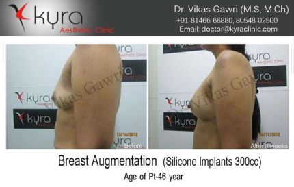 Breast Augmentation