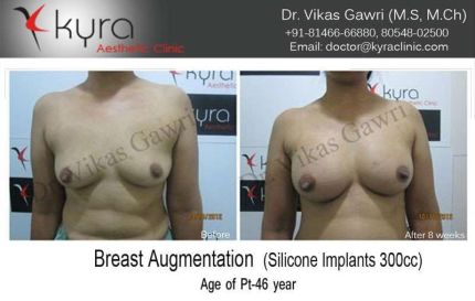 Breast Augmentation