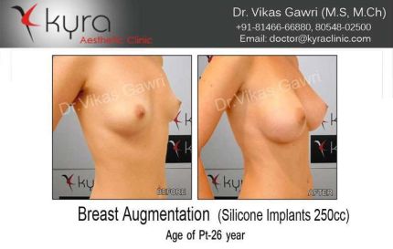 Breast Augmentation