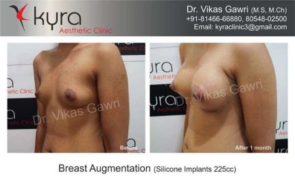 Breast Augmentation