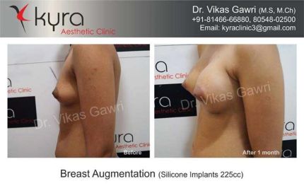 Breast Augmentation