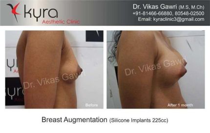 Breast Augmentation