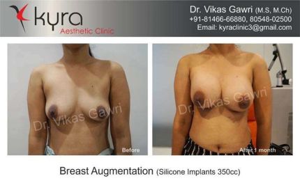 Breast Augmentation