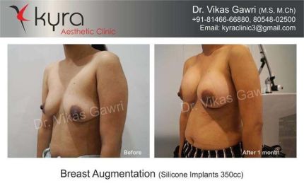 Breast Augmentation