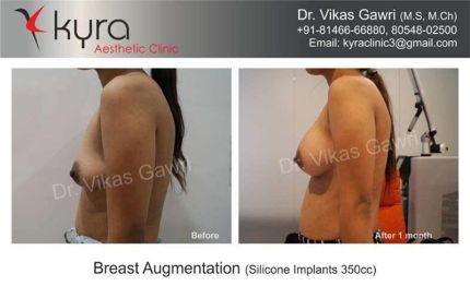 Breast Augmentation