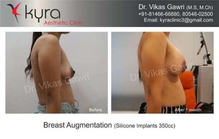 Breast Augmentation