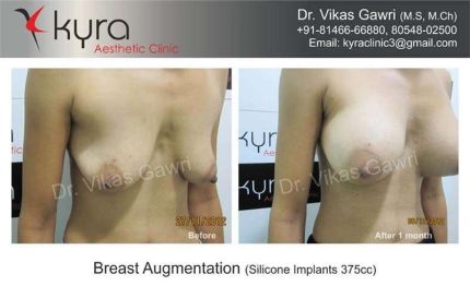 Breast Augmentation