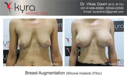 Breast Augmentation