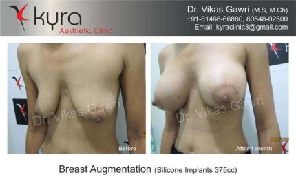 Breast Augmentation