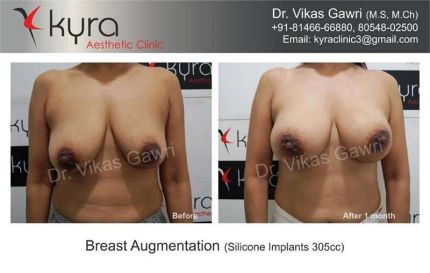 Breast Augmentation