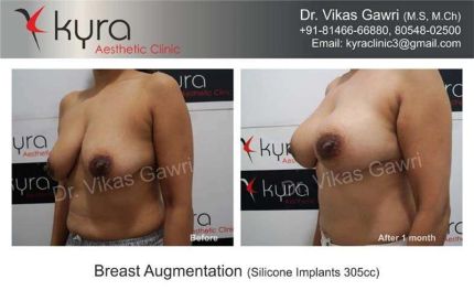 Breast Augmentation